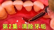 经常洗牙对牙齿有伤害吗?多久洗一次牙最好?这一堆牙垢就是答案时尚完整版视频在线观看爱奇艺