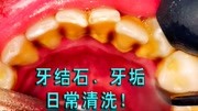 一年洗几次牙比较好?5年不洗牙的牙结石有多厚?洗牙过程很解压健康完整版视频在线观看爱奇艺