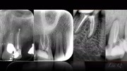 根管治疗xray健康完整版视频在线观看爱奇艺