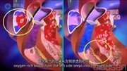 好医友分享:先天性心脏病(CHD)医疗科普生活完整版视频在线观看爱奇艺