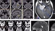 神经外科手术 脑科医院 肿瘤手术 神外 培训班1000G视频资料 理论资讯搜索最新资讯爱奇艺