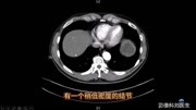 患者腹部CT发现肝脏占位,医生却说别担心?医生分享典型病例生活完整版视频在线观看爱奇艺