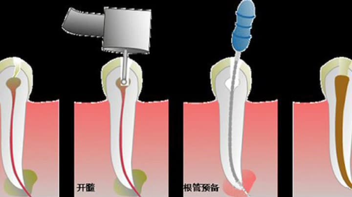 为什么根管治疗后的牙齿医生会建议做牙套?