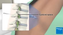 硬膜外麻醉 How an epidural is given during childbirth