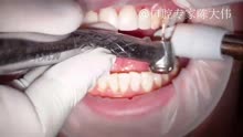 【口腔专家陈大伟】牙齿美学修复是怎么做的呢？