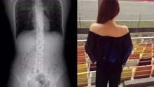 上海女子吃辣被呛咳断4根肋骨，医生说出原因让人无语：太瘦了！